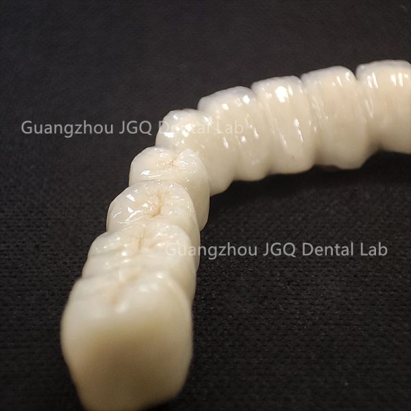 China Dental Lab Fabricated Dental Pfm Bridge Teeth Fast Fitting Customized