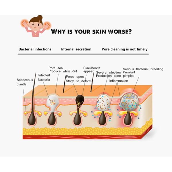 DC 5V Electric Pore Cleanser Blackhead & Acne Remover Rechargeable 2600MAH Battery