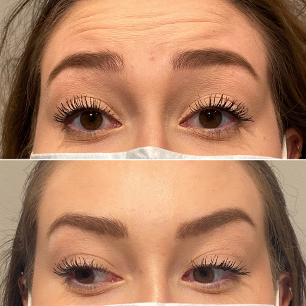 Токсин блоков Hyamely 100 Botulinum для Remove сморщивает впрыску Botox