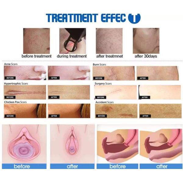 L' équipement de beauté pour le renouvellement de la peau par laser de CO2 fractionné