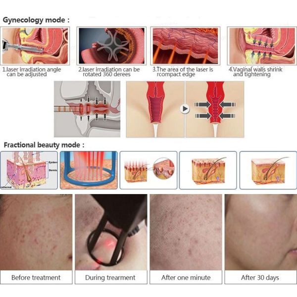 Germany Fractional CO2 Laser Skin Resurfacing Lattice Laser Skin Beauty Machine