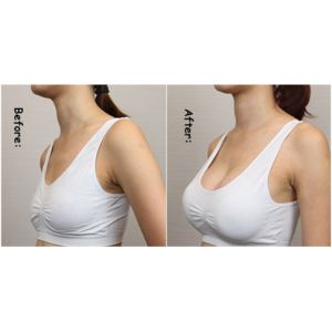 Aglomerante de ácido hialurónico inyectable para labios Rugas faciales Ampliación mamaria Inyecciones de llenado de glúteos