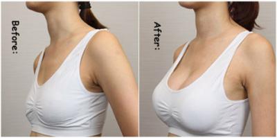 Injectable Hyaluronic Acid Ha Filler For Lips Facial Wrinkle Breast Enlargement Buttock Filler Injections