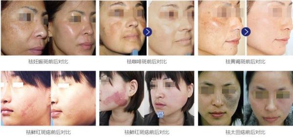 1064nm 532 nm 1320nm  Q Switched Nd Yag Laser  Machine :Pigment removal,Tattoo removal,Skin rejuvenation.Hair removal