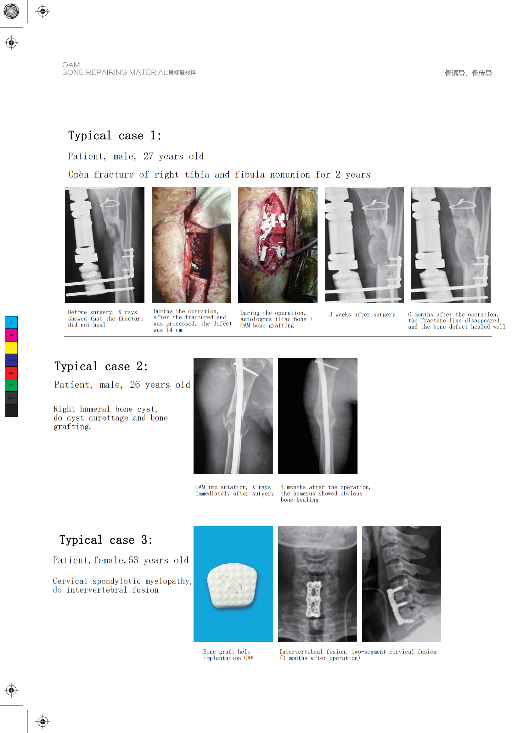 Bovine Bone Graft Substitute Sterile Packaging