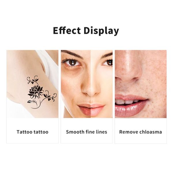 Q Switched ND Yag Laser Tattoo Removal Machine 1064nm Picosecond Laser Tattoo Removal Machine