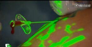 High Contrast Image Vein Light Vein Locator Device For Medical Puncture by Projection