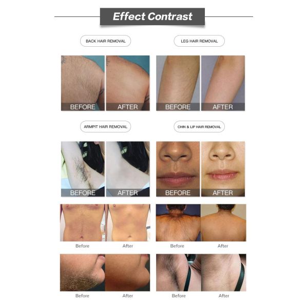 755nm 808nm 1064nm Diode Laser Hair Removal Machine 10HZ