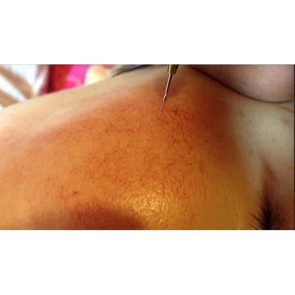 Factory Price Spider Vein Removal Machine / Veins Removal Machine / Facial Vein Removal