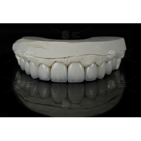 0.3mm-0.7mm Feldspathic EMAX Ceramic Veneers Natural Aesthetic Emax Dental Veneers