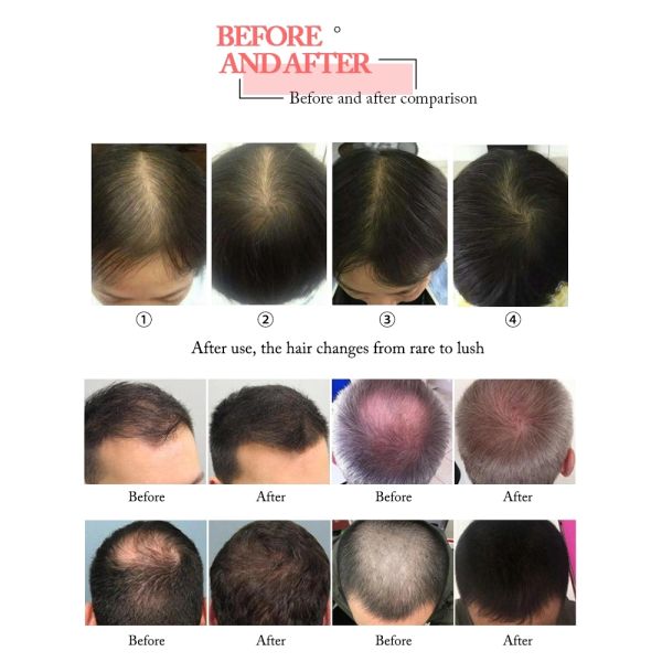 машина ХР208 терапией лазера машины роста волос диода 660нм гарантия 1 года