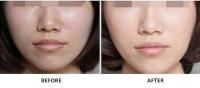Sódio ligado não transversal Hyaluronate que rejuvenesce a injeção para cuidados com a pele