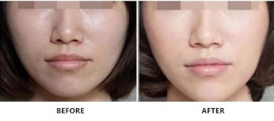 Sódio ligado não transversal Hyaluronate que rejuvenesce a injeção para cuidados com a pele