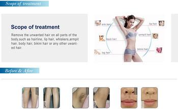 Painless treatment 808nm diode laser permanent hair removal / skin rejuvenation machine
