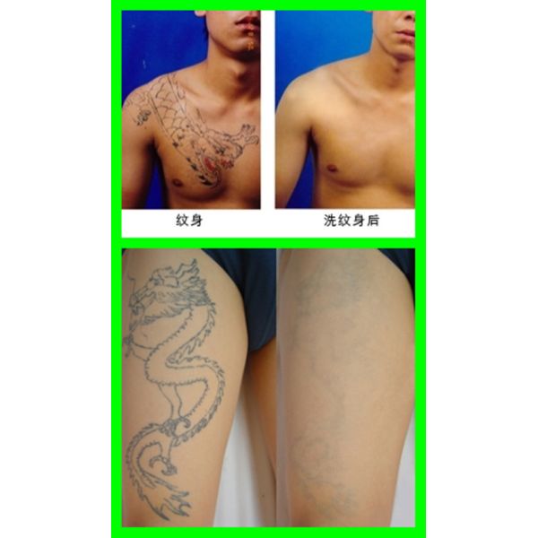 Female Beauty Salon Portable Mini Q Switched Yag Laser For Hyperpigmentation