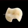 Digital Empress Onlay And Inlay Customized By Dental Prosthesis Laboratory