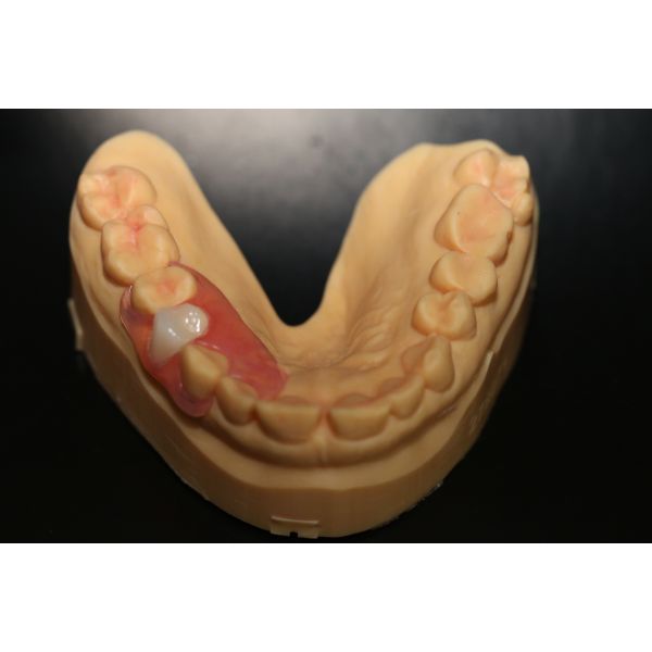 Flexible Partial Denture Lab | Natural Look TCS Flexible Denture Stain Resistant