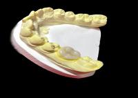 Inlays e Onlays Cerâmicos de Alta Qualidade para Restauração Dentária Sem Secções e de Longa Duração