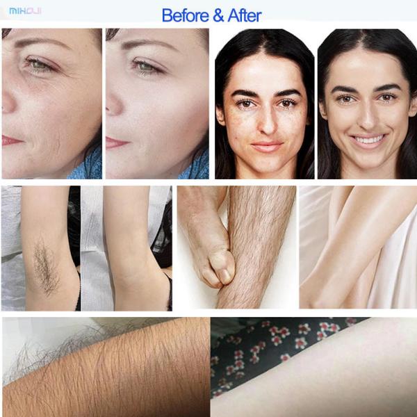 Máquina de laser Nd Yag Soprano 808nm para remoção de cabelo e tatuagem