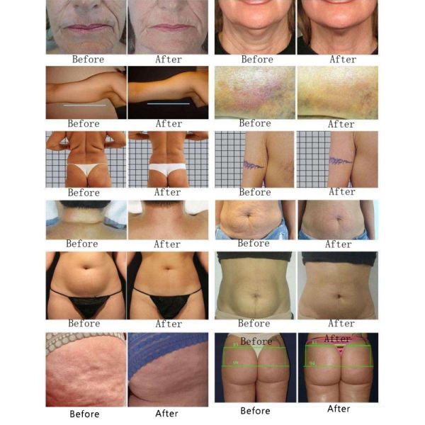 4 In1 Hair Removal Diode Laser Tattoo Removal Q Switched Nd Yag Laser 755 808 1064nm Hair Removal Machine