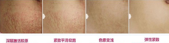 Best choice RF Metal Tube Acne scar removal Fractional Co2 Laser Machine