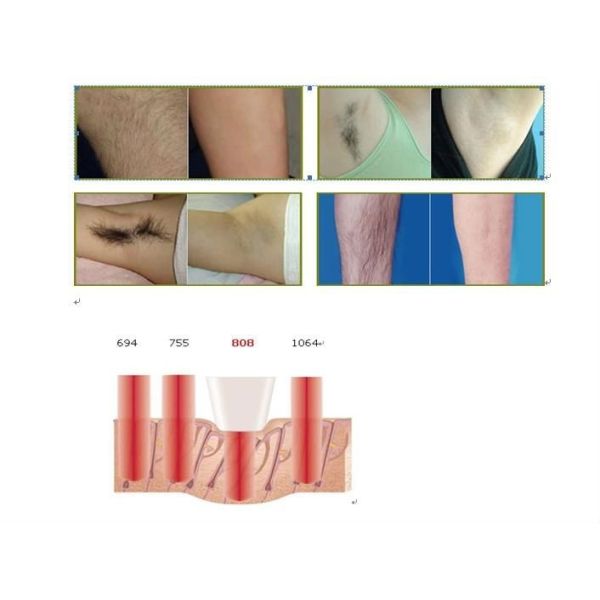 High Energy Big Spots 808nm Diode Laser Hair Removal Machine 12 Pieces Laser Bar