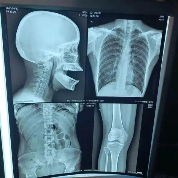 200±5μM Thickness Medical X Ray Film For Diagnostic High Density