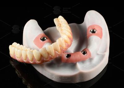 Composite Pink Porcelain Crown A1 Shade All On 4 Hybrid Titanium Screw Retained