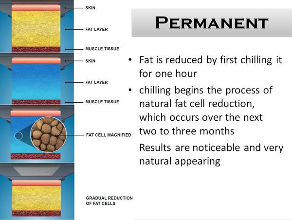 Cryolipolysis slimming equipment Cryo cool shape body slimming machine cryolipolysis cavitation machine
