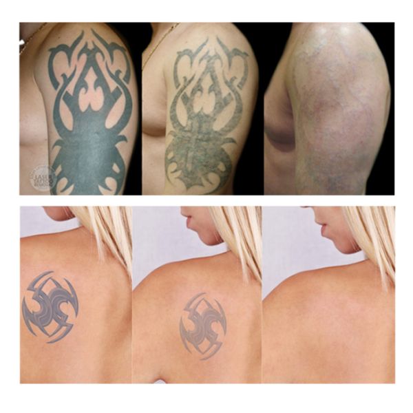 Colour Tattoo Removal ND YAG Laser Machine For Clinics Photothermolysis Based