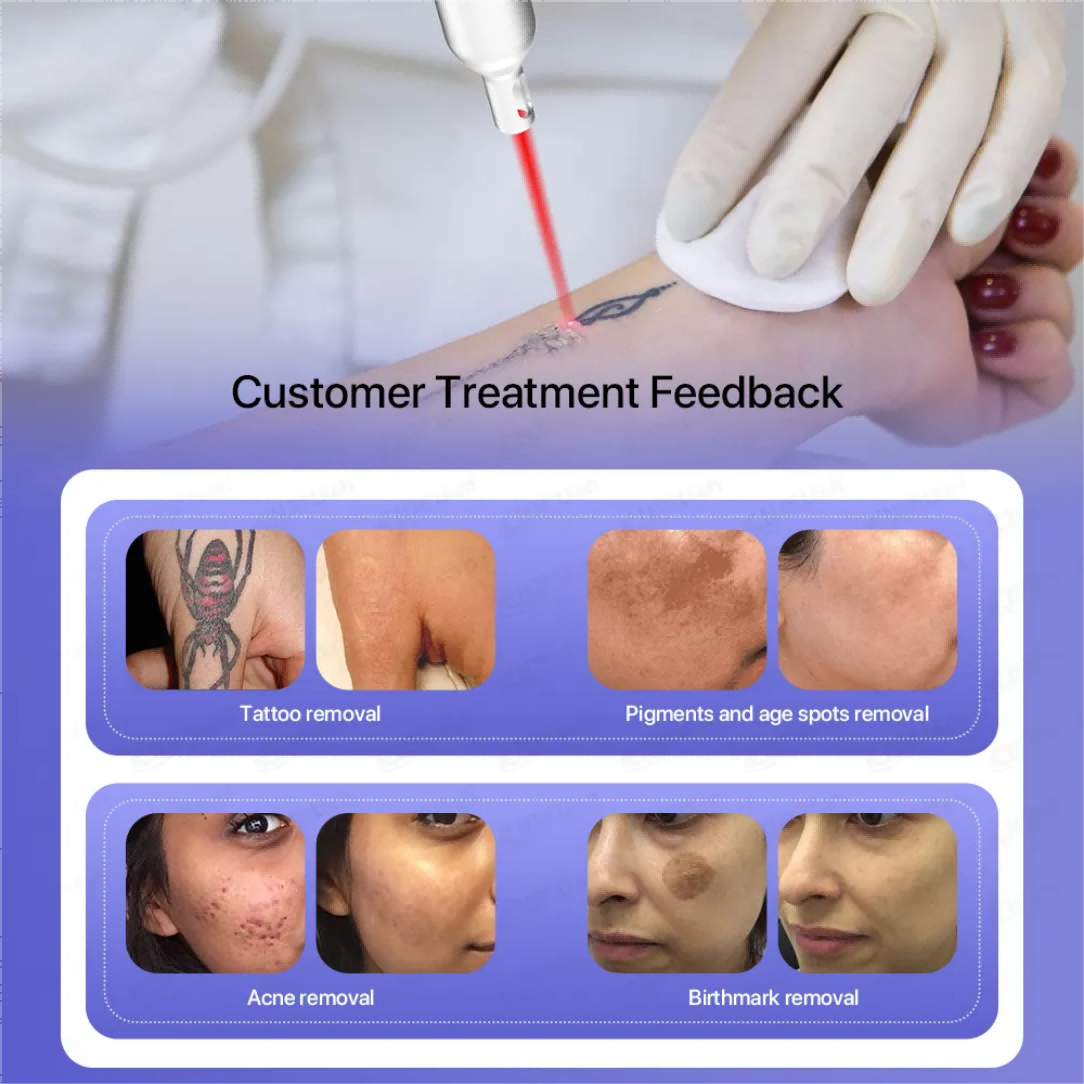 Non Invasive Pigment Removal Machine 3000W Facial Brightening Picosecond Laser Machine