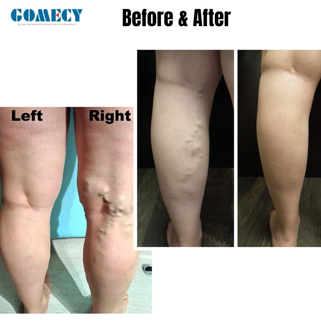 1940nm Diode Laser For Varicose Vein Removal Varicose Veins Laser Machine EVLT 1940 Varicose Veins Laser Treatment