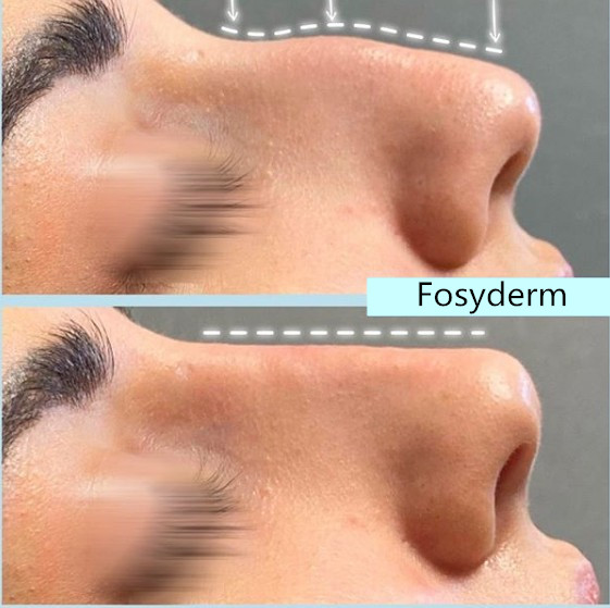 Заполнитель Fosyderm глубокий дермальный для кислоты Chin HA носа Hyaluronic