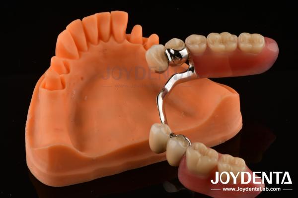 Framework Setup Teeth Finish Elaborate Technology Beautiful Harmonious Appearance Design