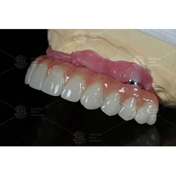 China Dental Lab Fast Turnaround Time In 72 Hours Provides High Quality All on X
