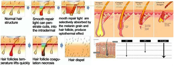 IPL SHR Elight 3 in 1 hair removal machine for Spa Salon use