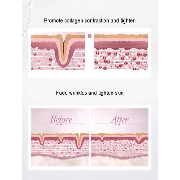 Skin Rejuvenation RF Beauty Instrument