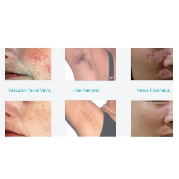 New technology alexandrite laser 755 for hair removal brown spots