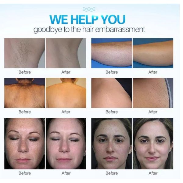 Effective Painless 808nm Diode Laser Hair Removal Machine CE / FDA Approved