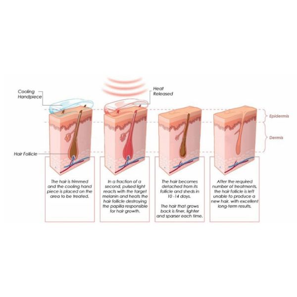 Ice Platinum Diode Laser Hair Removal Machine 1000W For Skin Rejuvenation