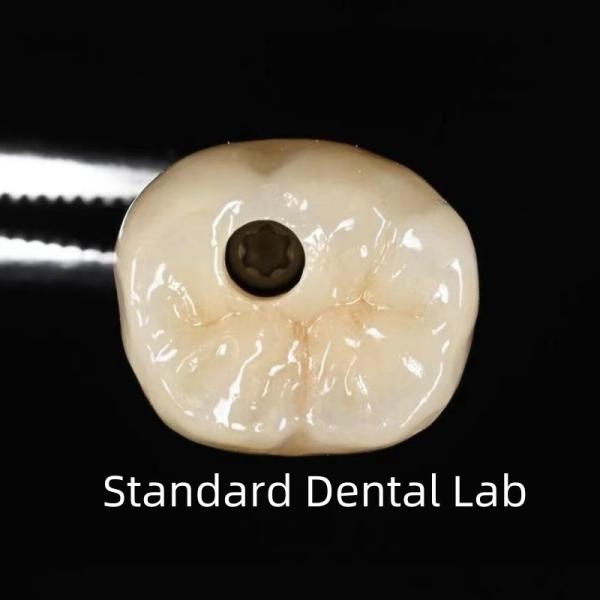 Couronne d'implant dentaire à vis
