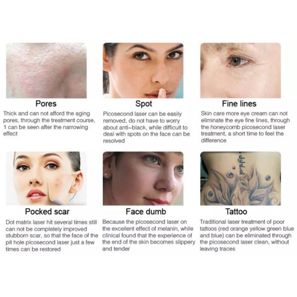 1064nm 532nm 1320nm Carbon Peel Q Switch ND Yag Laser Tattoo Removal Machine For Salon