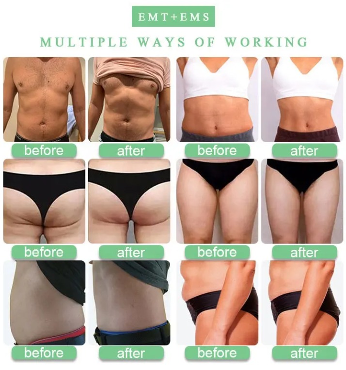 Аппарат для укрепления мышц и подтяжки ягодиц Hiemt Ems с 4 манипулами, 7 Тесла, для похудения и коррекции фигуры