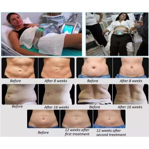 Lipolaser Cryolipolysis Slimming Machine 40Khz 5 In One Cavitation Machine