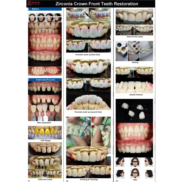 Denture False Teeth PFZ Crowns Bridges Chinese Dental Lab Customized