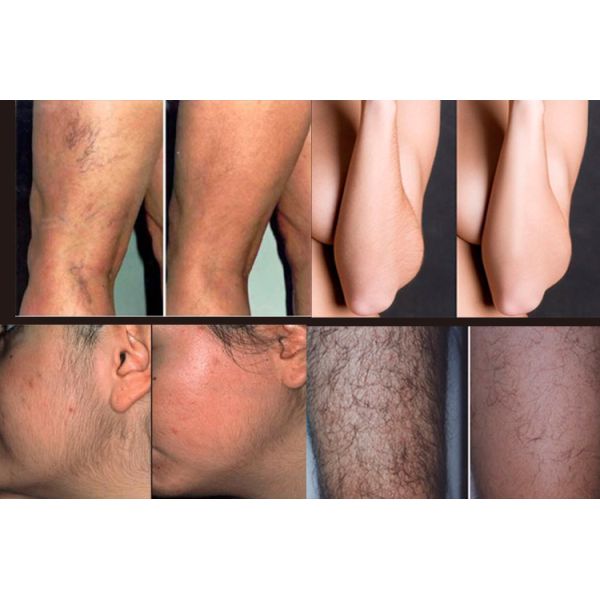 Vertical Diode Laser Hair Removal Machine Gold Standard Pain Free For Salon