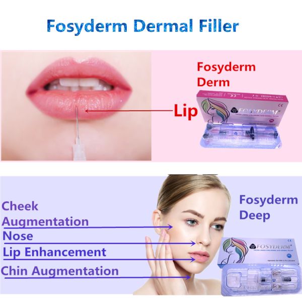 крест 1ml соединил Hyaluronic кисловочный дермальный заполнитель для губ обнюхивает Chin