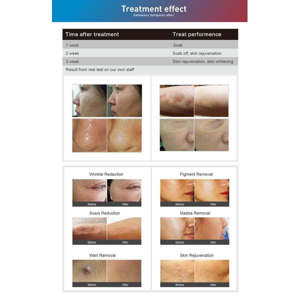Профессиональная 60 Вт RF трубка Q-свича фотона фракционный CO2 лазерная машина для восстановления кожи