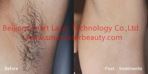 Cheap OPT SHR IPL Hair Removal Machine With 500000 Shots UK Lamps