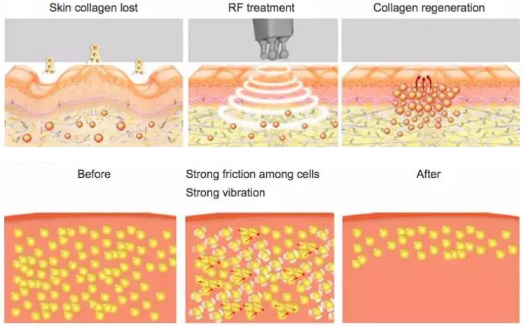 Vacuum Rf Lipolaser 40khz Body Cavitation Machine